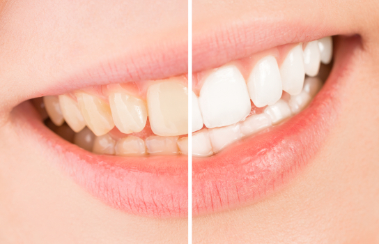 Teeth Straightening Teeth Whitening Skerries